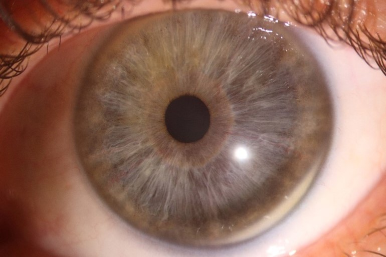 Matters of size: when is the cornea too large?