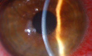 Contact lens-related keratitis in New Zealand