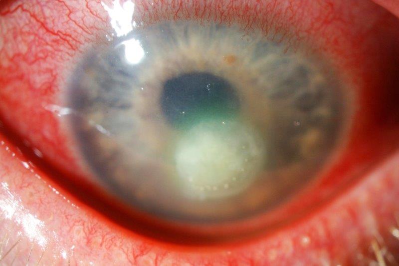 Risks of topical ocular antibiotics and corticosteroids