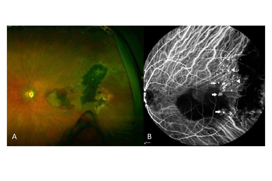 Diagnosis and management of macular polypoidal choroidal vasculopathy