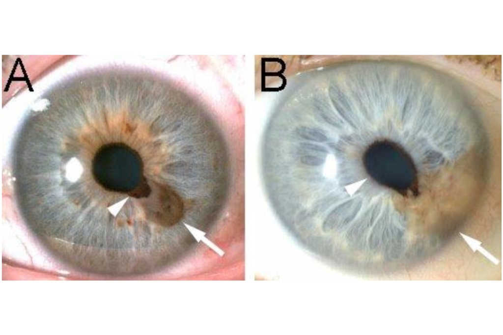 The iris in health and disease part 1 normal variations and mass