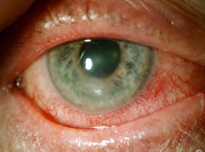 Risks of topical ocular antibiotics and corticosteroids - nzoptics