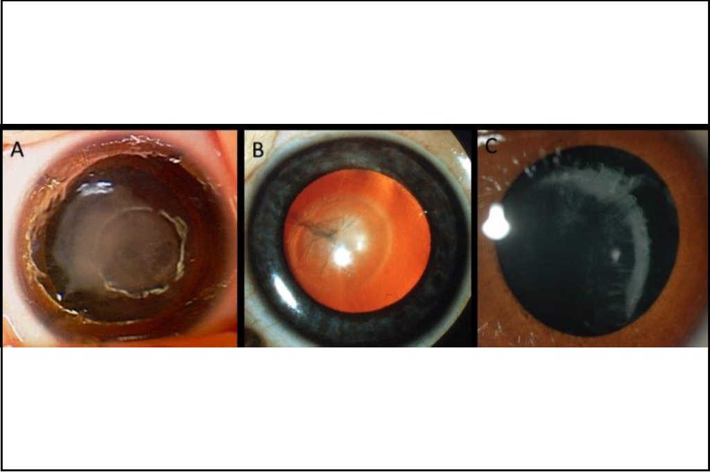 Genetic advances and impact on paediatric eyecare: focus on congenital cataract