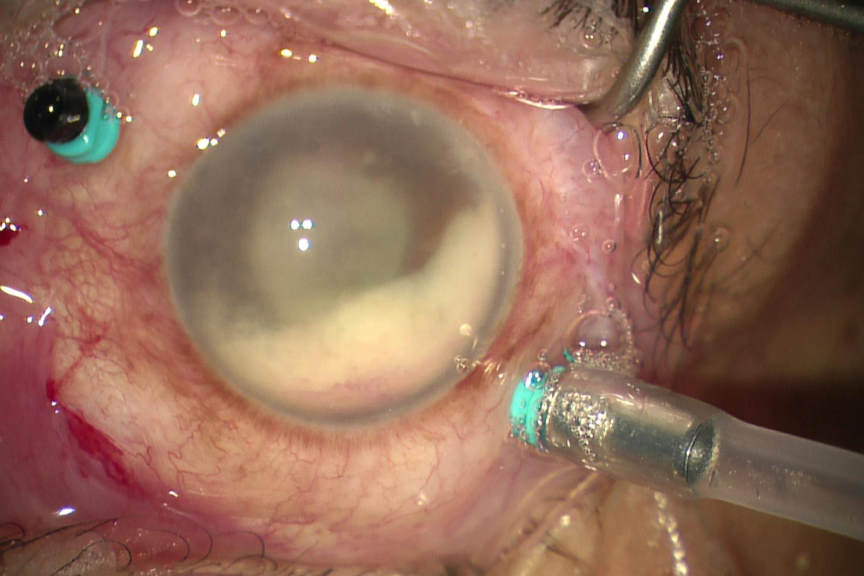 Fig 3a & b. The presence of fibrin and a hypoyon often makes the view of the posterior segment difficult. Fig 3a demonstrates this difficulty and fig 3b illustrates the utility of removing this material