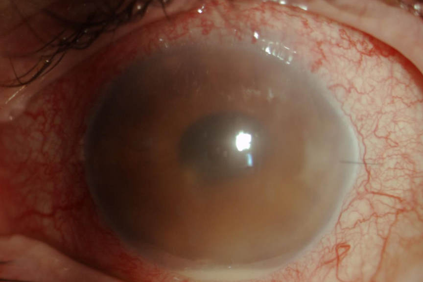 Fig 2. Post-cataract endophthalmitis. This diabetic patient had complicated cataract surgery and presented three days after surgery with a painful eye. The cornea is oedematous and a hypoyon is present