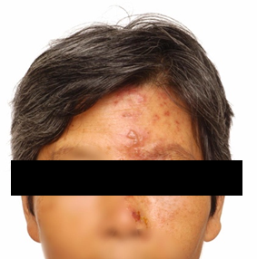 Fig 1. A female with a periocular vesicular rash in the distribution of the left ophthalmic branch of the trigeminal nerve, causing periorbital swelling and associated ptosis